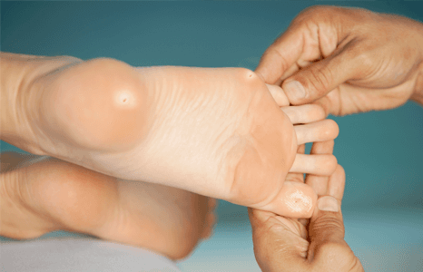 Corns and calluses removal
