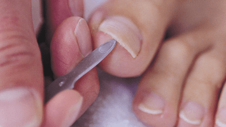 Thickened toenails