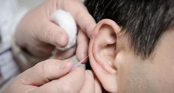 Ear Acupuncture