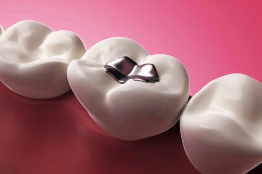 Teeth Filling — Dental Health in Oakhurst, CA Teeth Filling — Dental Health in Oakhurst, CA