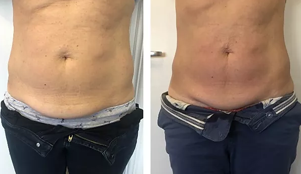 Skin tightening Before and After