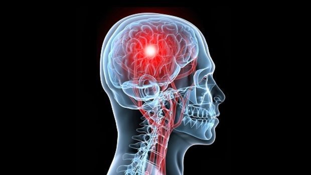 Una radiografía de una cabeza humana con una mancha roja en el medio del cerebro.