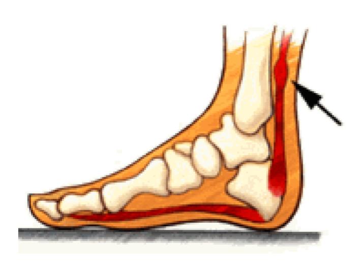 A drawing of a foot with a red arrow pointing to the ankle