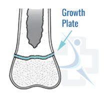 An example of growth plate