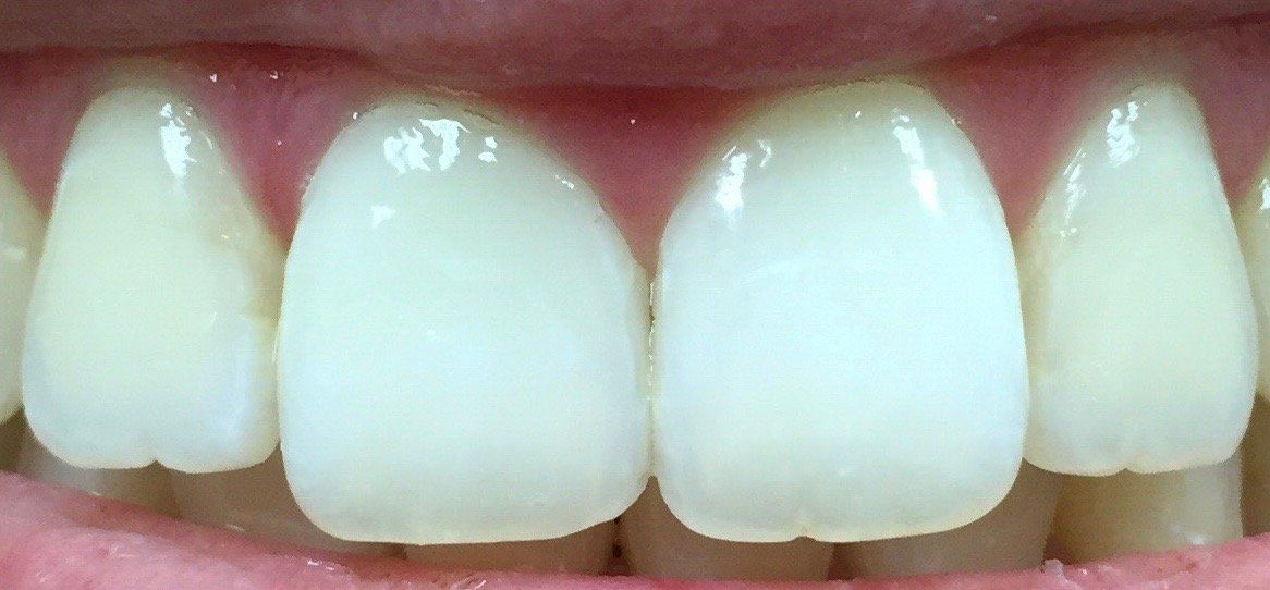 After Resin Infiltration