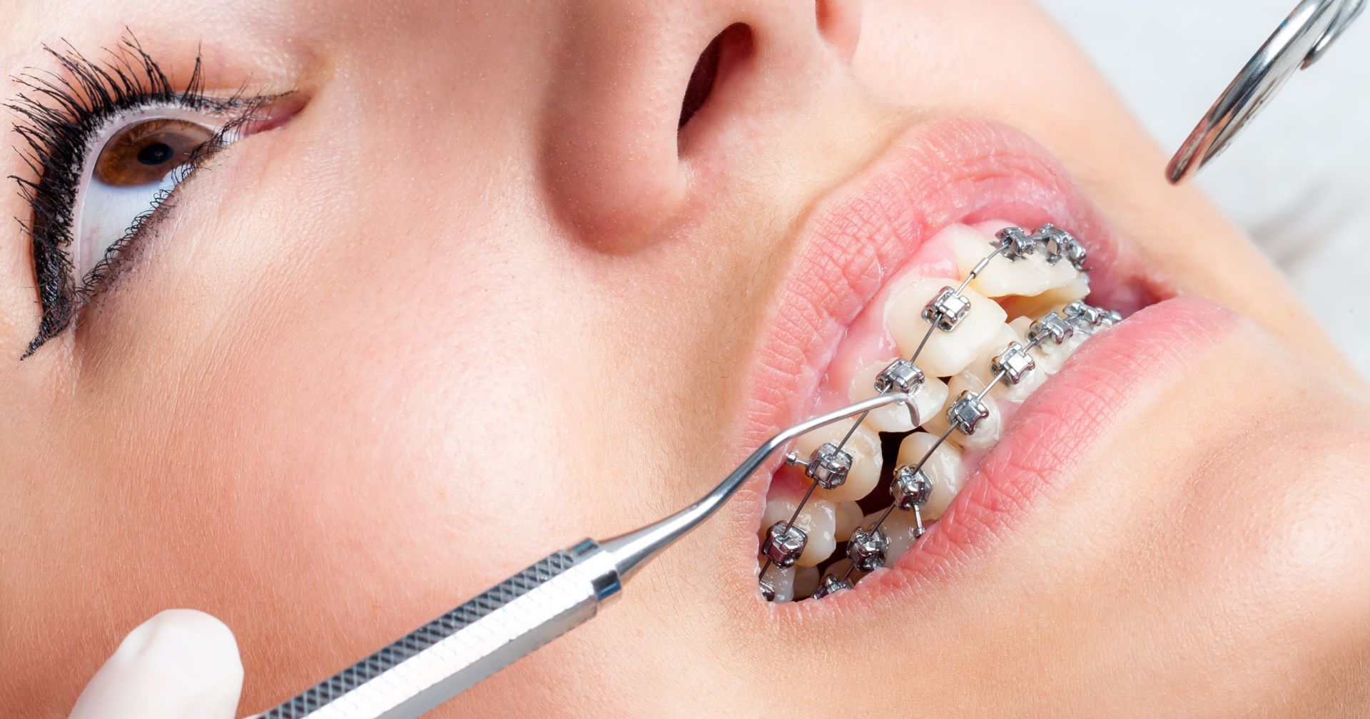 Conventional & Cosmetic Braces Services - Dansville Family Dental Care
