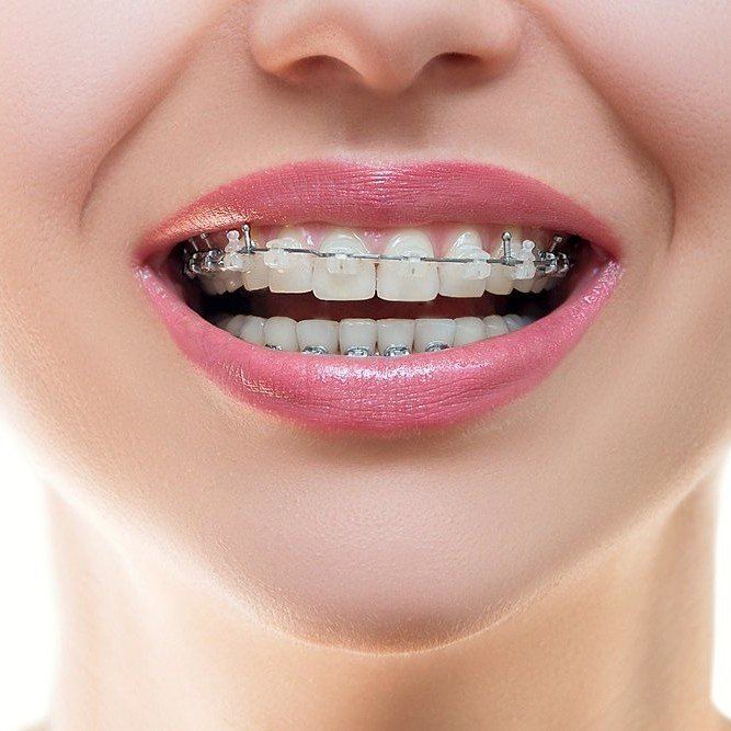 woman showing her braces