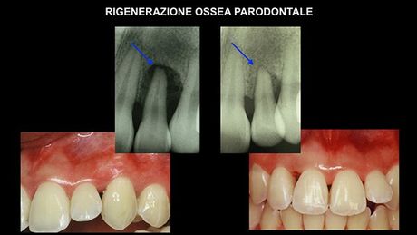 Sanguinamento e infiammazione gengivale