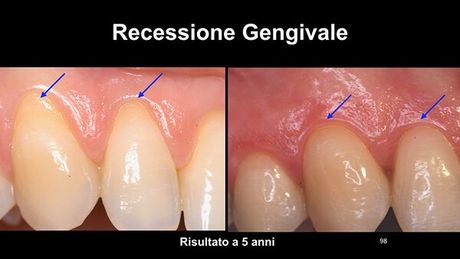 Retrazione gengivale-l-aquila