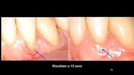 Retrazione gengivale