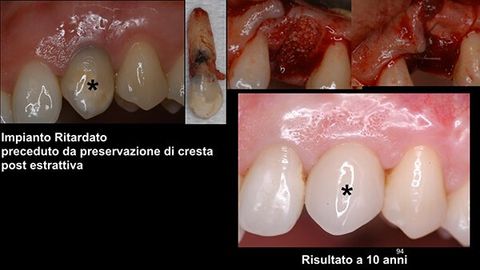Qualità e quantità del tessuto osseo e g-l-aquilaengivale