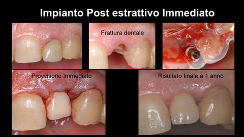 Qualità e quantità del tessuto osseo e gengivale