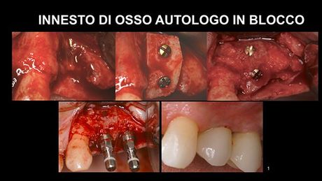 Qualità e quantità del tessuto osseo e gengivale