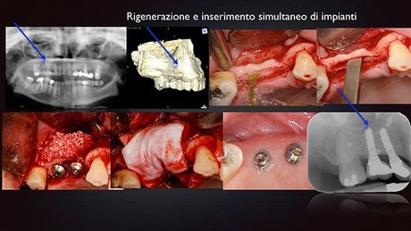 Qualità e quantità del tessuto osseo e gengivale