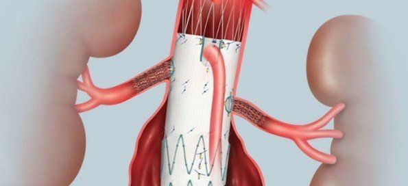 A computer generated image of a kidney with a device attached to it.