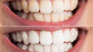Teeth Whitening — Teeth Whitening Before and After in Redding, CA Teeth Whitening — Teeth Whitening Before and After in Redding, CA