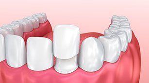 Veneers — Veneers 3D Drawing in Redding, CA Veneers — Veneers 3D Drawing in Redding, CA
