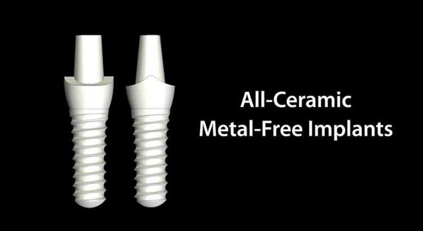 Ceramic Implant Restorations