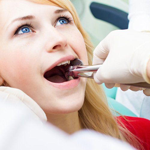 Tooth Extractions