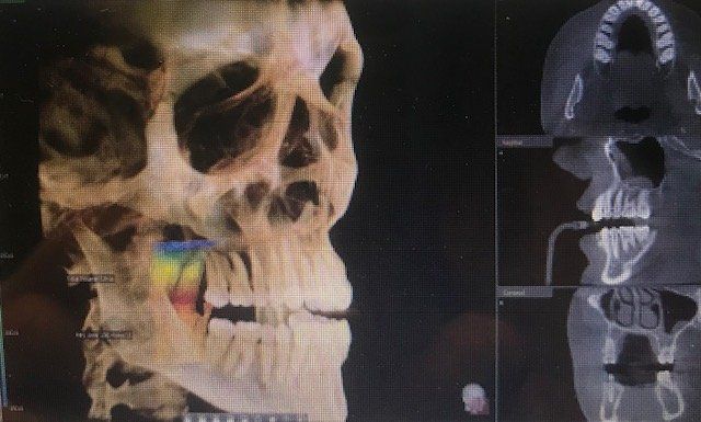 CBCT digital 3D imaging (extreme low X-ray and no uncomfortable films in your mouth)