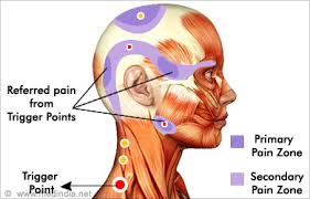 Trigger Point Injection