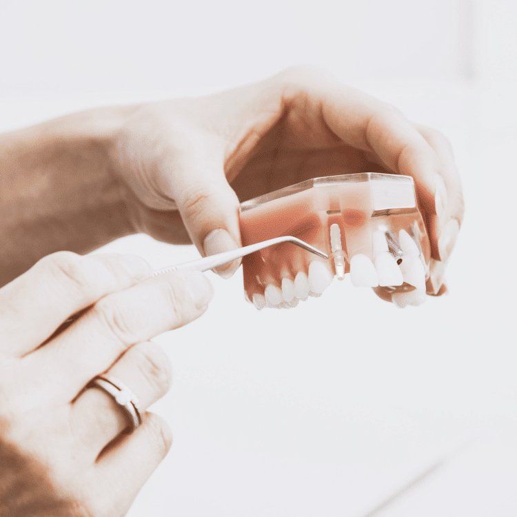 Dental Implants