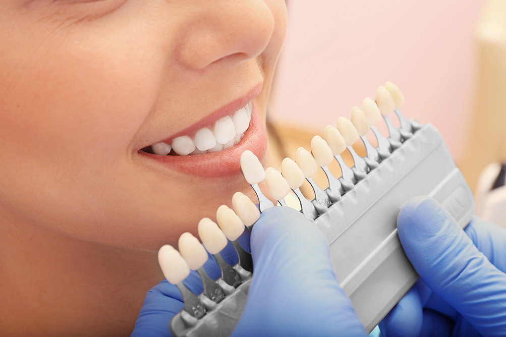 Veneers & laminates