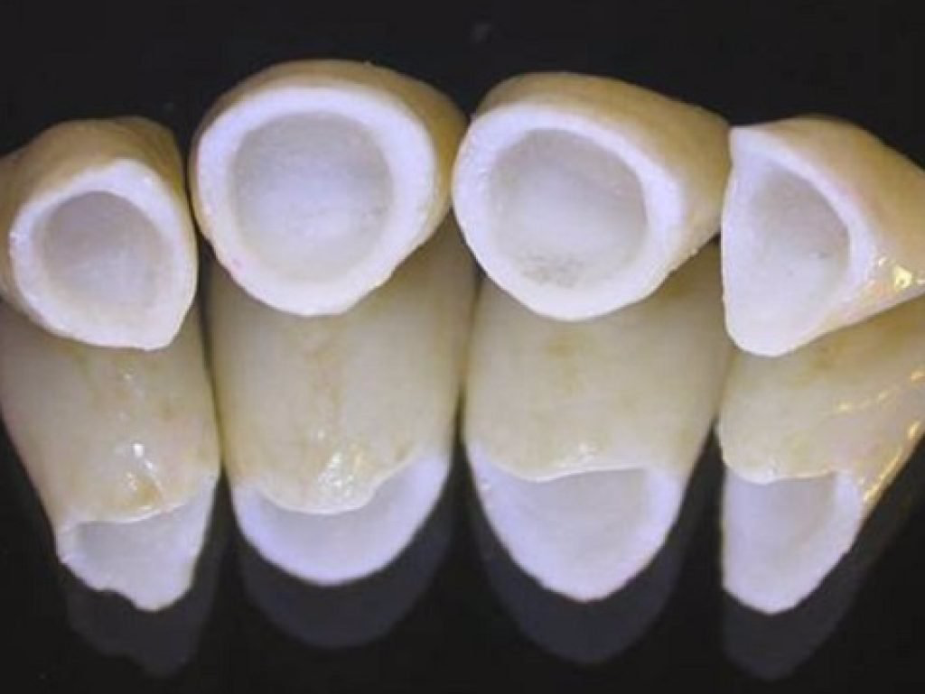 Corone in Ceramica: Studio Dentistico Vecchiotti Marco Cesena