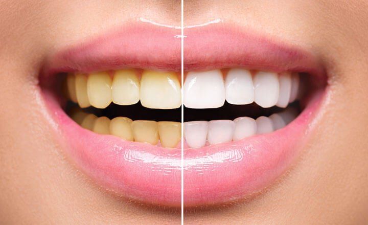Cura delle Carie: Studio Dentistico Vecchiotti Cesena Cura delle Carie: Studio Dentistico Vecchiotti Cesena