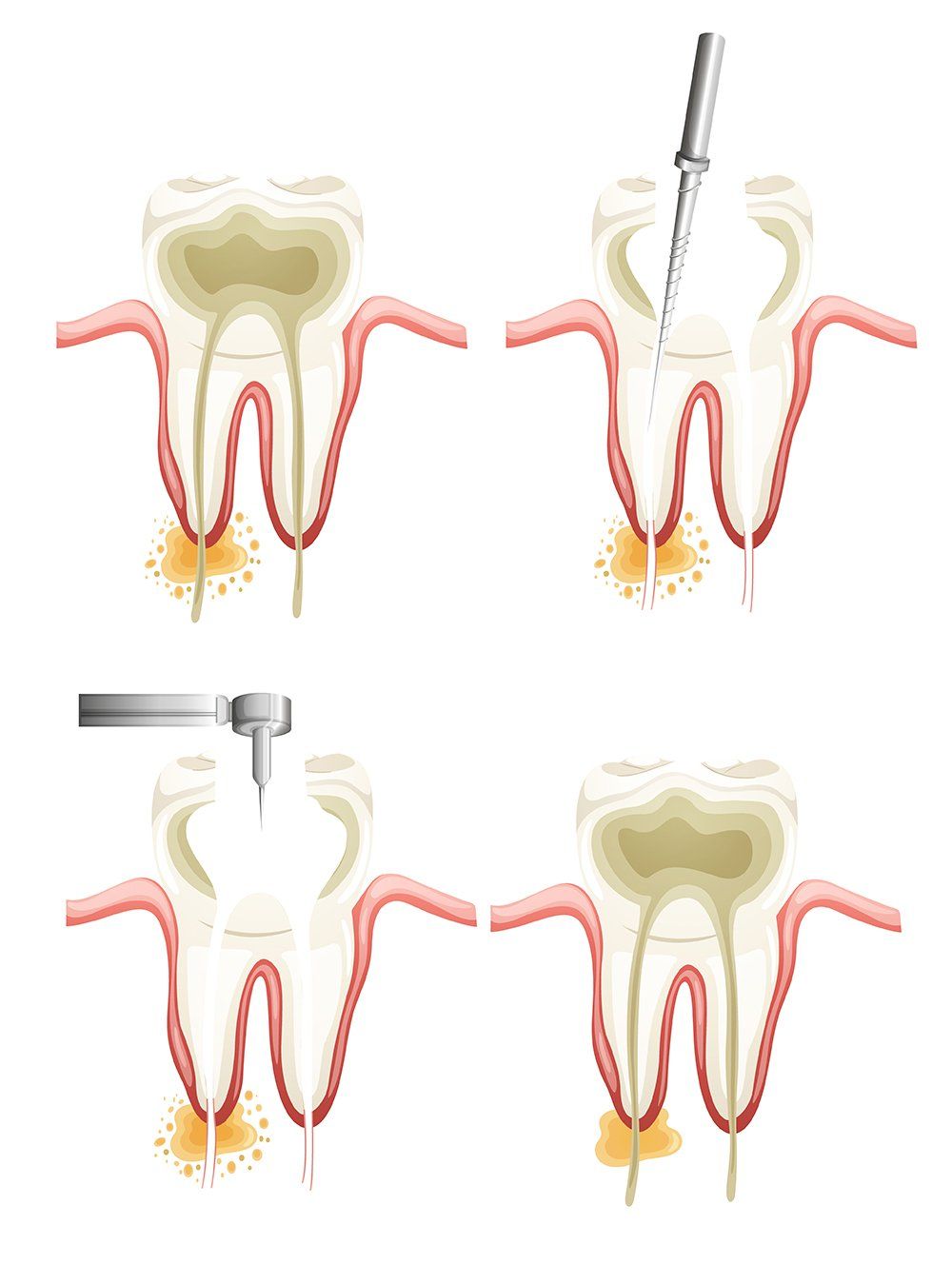 Root Canal Treatment Root Canal Treatment