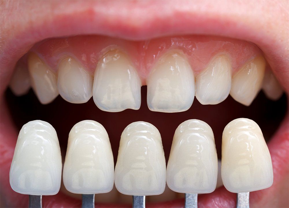 Veneers & Laminates Veneers & Laminates