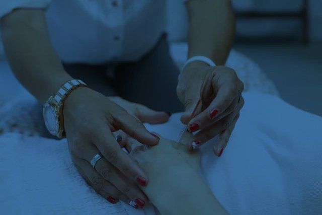 dry needling
