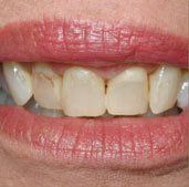 Porcelain Veneers in Anderson, SC