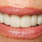 Porcelain Veneers in Anderson, SC