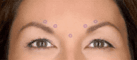 Botox treatments Anderson, SC
