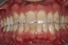 Teeth Whitening in Anderson, SC