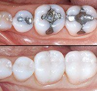 Toothache and Fillings Anderson, SC