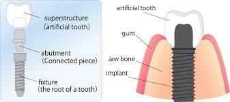 Cosmetic Dentist  Providing Dental Implants in Anderson, SC