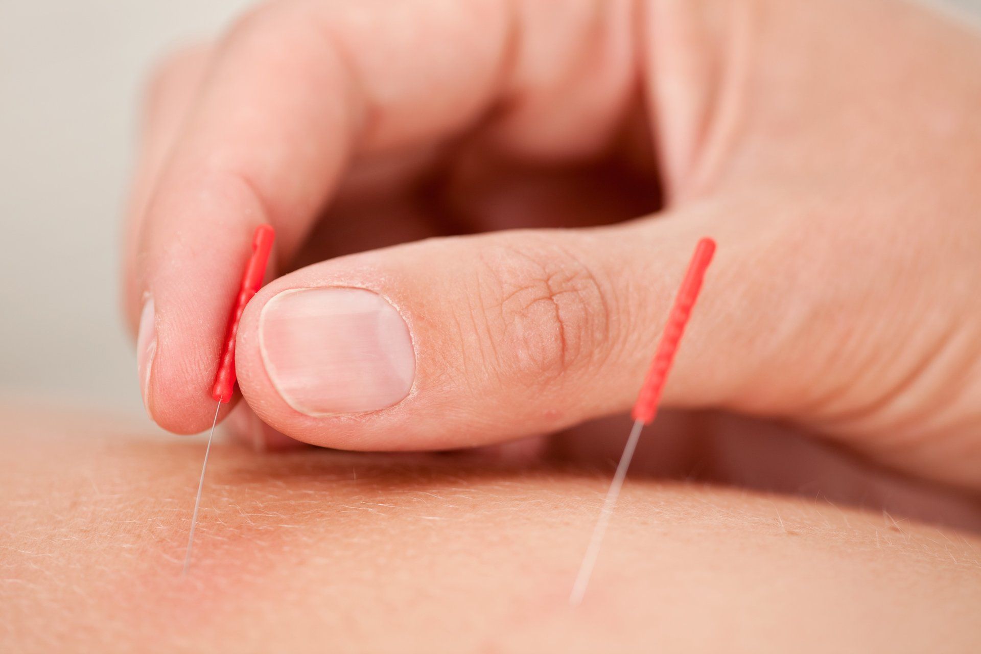 Medical acupuncture in Luton medical acupunture, sports massage, Leagrave, Luton