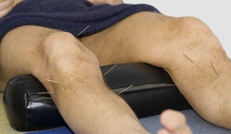 Medical Acupuncture in Luton Medical acupuncture and sports massage, Leagrave, Luton