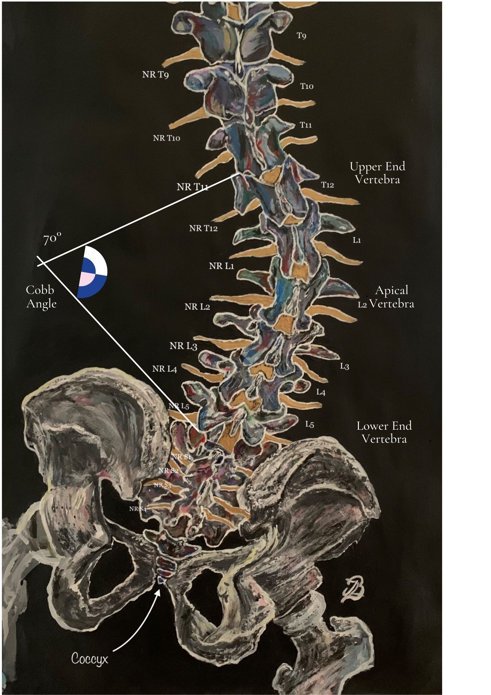 angle of scoliosis