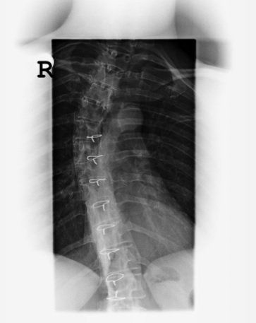 Xray of Scoliosis