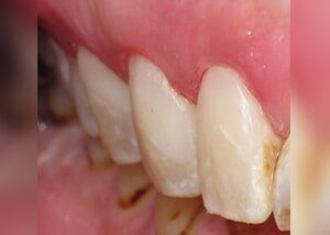 Composite fillings to restore decay - After — Teeth and Gums in Lincolnton, NC