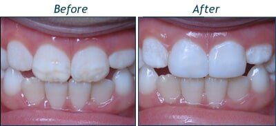 Bailey Before and After — Testimonials in Lincolntonm NC