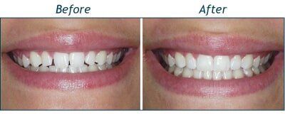 Bradley Before and After — Testimonials in Lincolntonm NC