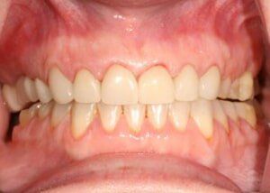 Porcelain crowns restore — Teeth and Gums in Lincolnton, NC