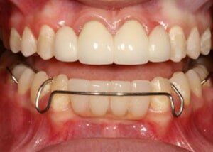 Bridge to replace issing laterals - After — Teeth and Gums in Lincolnton, NC