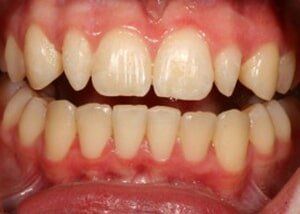 Bonding for “peg laterals” - Before — Teeth and Gums in Lincolnton, NC