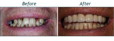 Senior Couple Before and After — Testimonials in Lincolntonm NC