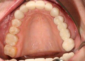 All porcelain crowns, bridges and composite restorations - After — Teeth and Gums in Lincolnton, NC